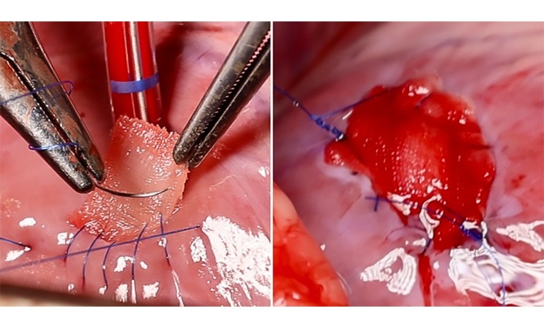 Image: The support scaffold is implanted into the heart defect and covered with the mesh (Photo courtesy of Soft Robotics Laboratory/ETH Zurich)