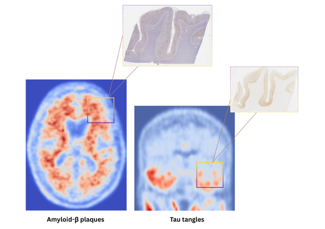 Image: Image shows amyloid and tau PET scans, and corresponding protein (amyloid and tau) deposits in each (Photo courtesy of Chobanian & Avedisian School of Medicine)