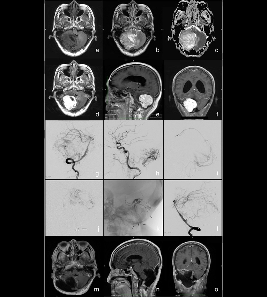 Image: Preoperative MRI/angiography showing large hypervascular right cerebellar tumor with feeding arteries; intraoperative embolization and postoperative MRI confirm complete removal after a single-session hybrid procedure (Wang et al., Chinese Neurosurgical Journal)