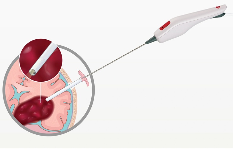 Image: The Artemis Neuro Evacuation Device (Photo courtesy of Penumbra)