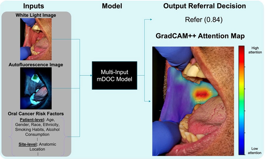 Image: Analysis of an anatomic site using the mobile Detection of Oral Cancer (mDOC) model (Photo courtesy of R. Mitbander et al., DOI: 10.1117/1.BIOS.2.4.042307)