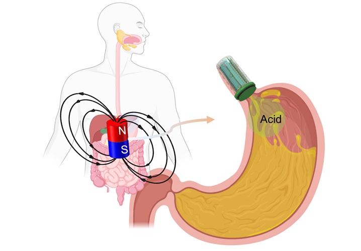 Image: The magnetic soft robotic valve offers a new minimally invasive solution for acid reflux (Yi Zhu et al., Device (2025). DOI: 10.1016/j.device.2025.100932)