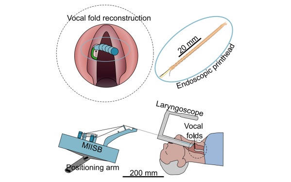 Image: Graphical abstract showing a minimally invasive in situ bioprinting method for vocal fold reconstruction (SAT Groen et al., Device (2025). DOI: 10.1016/j.device.2025.100973)