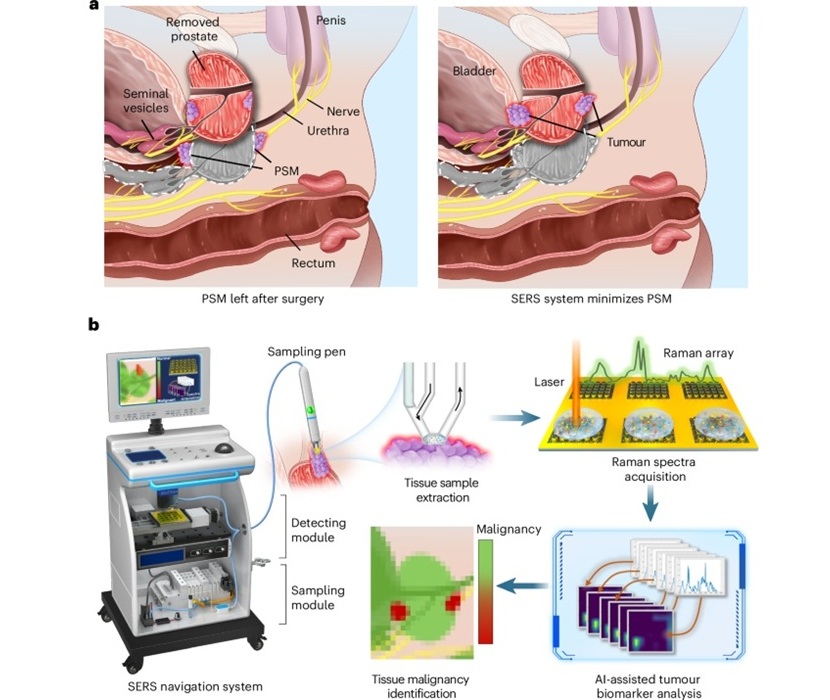Image: An on-site SERS navigation system for grading the malignancy of prostate tumors (Ziyi Jin et al., Nature Biomedical Engineering (2025). DOI: 10.1038/s41551-025-01561-y)