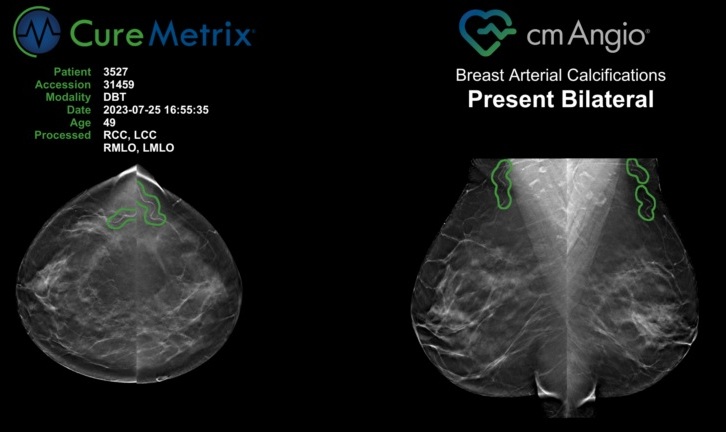 Image: The cmAngio AI-based detection software can identify breast arterial calcifications (Photo courtesy of CureMetrix) Image: The cmAngio AI-based detection software can identify breast arterial calcifications (Photo courtesy of CureMetrix)