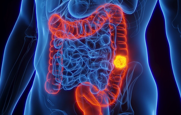 Image: AI has sharply improved colon cancer detection over the past five years (Photo courtesy of University of Sharjah)