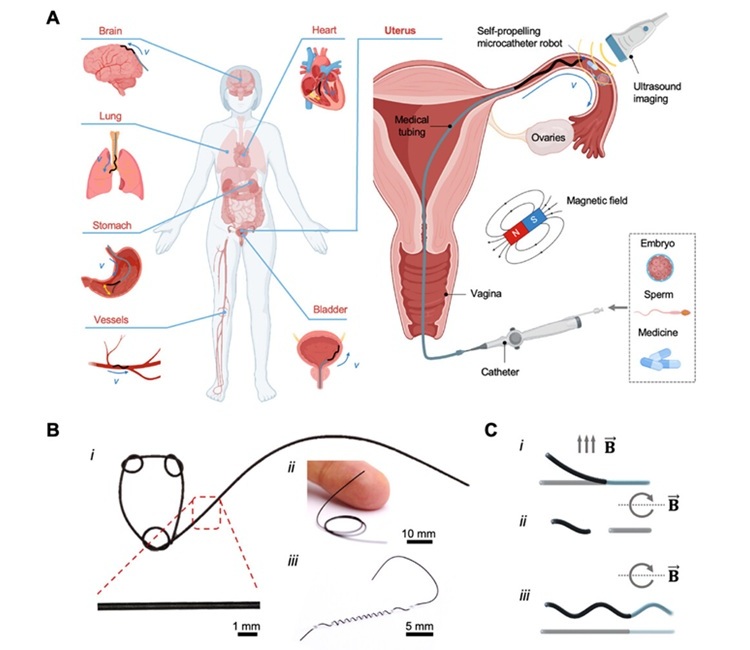 Image: The robotic magnetic microcatheter traverses the cervix into the vagina and fallopian tubes (Z Chen et al., Advanced Materials (2025). DOI: 10.1002/adma.202506591)