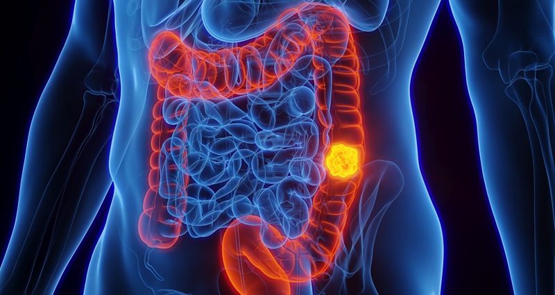 Image: AI has sharply improved colon cancer detection over the past five years (Photo courtesy of University of Sharjah)