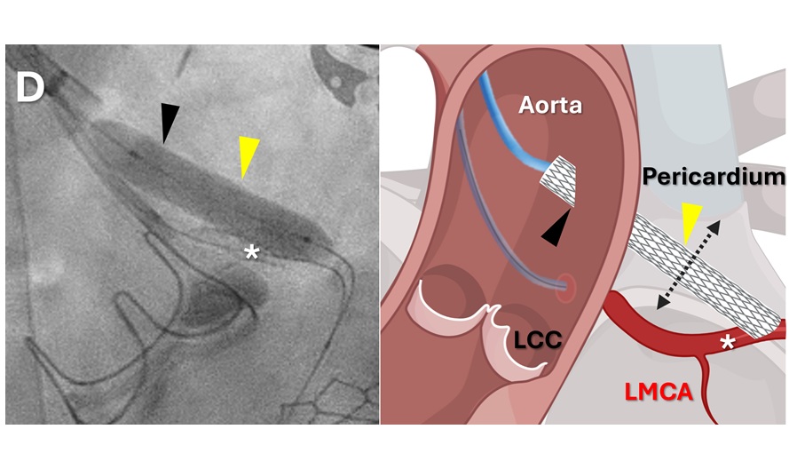 Image: A fluoroscopy image (left) and graphic representation (right) depict a stent graft (yellow arrowhead) being deployed (Photo courtesy of Bruce et al.)