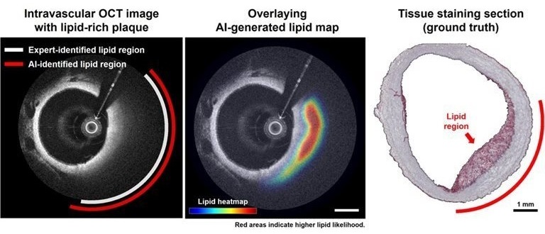 Image: The AI-based approach identifies lipid regions matched well with histopathology results (Photo courtesy of Hyeong Soo Nam/KAIST)