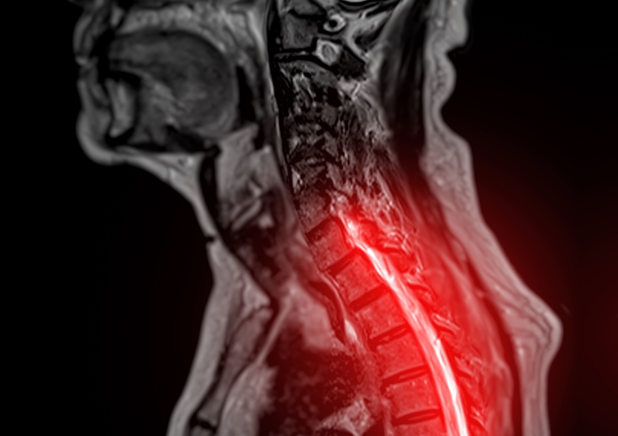 Image: Clinically informed AI outperformed foundation models in spinal cord disease prediction (Photo courtesy of Shutterstock)