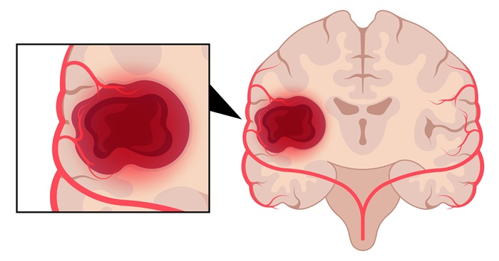 Image: The approach uses laser heat to ablate the tumor and disrupt the blood-brain barrier, with the aim of improving immunotherapy response (photo courtesy of Adobe Stock)