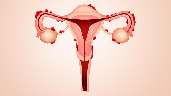 Image: The SAFE score questionnaire helps identify adolescents at risk of endometriosis (Photo courtesy of 123RF)