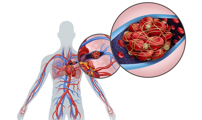 Image: Acute pulmonary embolism occurs when a blood clot blocks lung vessels and can become life-threatening in moderate- to high-risk patients (Pboto courtesy of Adobe Stock)