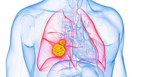 Image: Clinicians need accurate tissue diagnosis and staging of lung cancer with fewer complications and repeat procedures (photo courtesy of Adobe Stock)