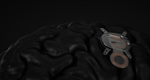 Image: The device combines a minimally invasive, long‑lifetime “read/write” brain‑computer interface (BCI) with assistive devices and AI-driven support (photo courtesy of Epia Neuro)