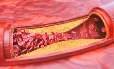 Image: A novel minimally invasive method to assess coronary blood flow restriction performed similarly to the standard invasive procedure (photo courtesy of Shutterstock)