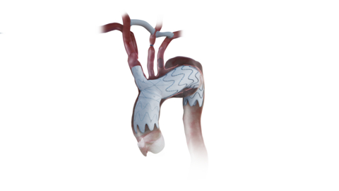 Image: The NEXUS System is a bimodular construct designed to mimic ascending aorta and arch anatomy (photo courtesy of Endospan)