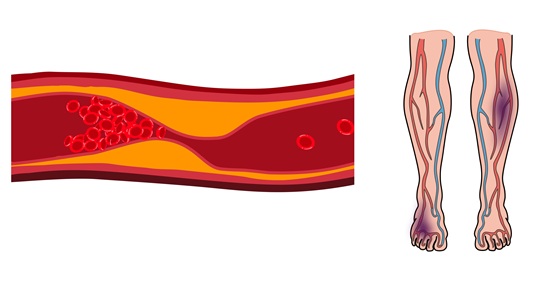Image: Chronic limb-threatening ischemia (CLTI) is a severe stage of peripheral artery disease (PAD) marked by plaque buildup that narrows leg arteries and restricts blood flow (photo courtesy of Shutterstock)