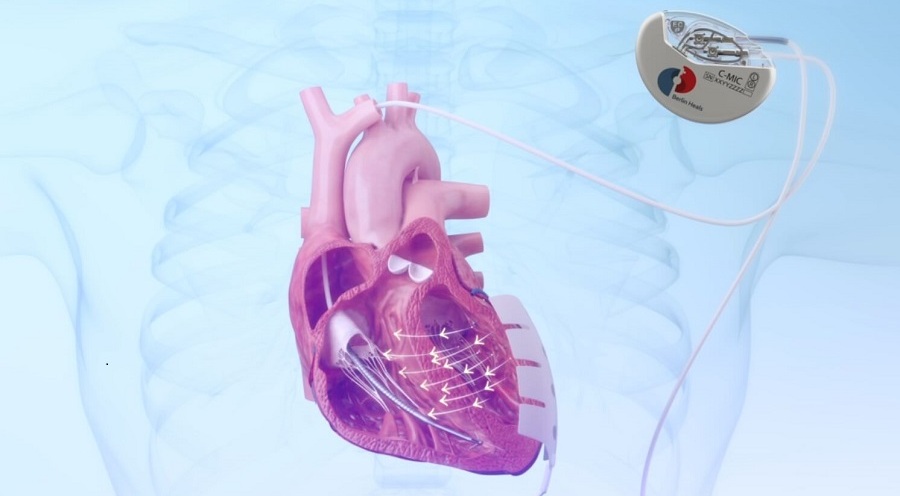 Image: The C-MIC device is a novel cardiac implant that redefines heart failure therapy (Photo courtesy of Berlin Heals)