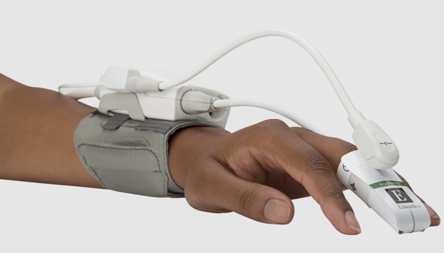 Image: The approach pairs the ASI algorithm with the Acumen IQ finger cuff from Edwards Lifesciences to screen for clinically significant aortic stenosis (photo courtesy of Edwards Lifesciences)