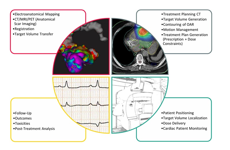 Image: Overview of STAR as an interdisciplinary approach combining cardiology and radiation therapy (photo courtesy of UKSH)