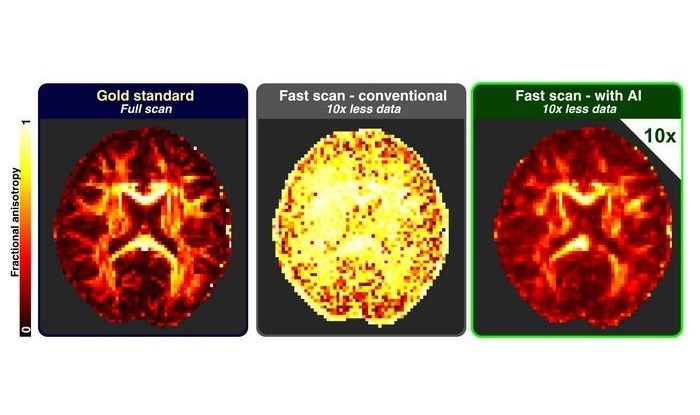 Image: By training the AI with simulations, researchers can reconstruct brain images with high precision using only one-tenth of the data typically required in magnetic resonance imaging. The image shows a metric known as “fractional anisotropy”—an index of myelination—obtained using conventional methods and with the new approach (Photo courtesy of Instituto de Neurociencias UMH CSIC) Image: By training the AI with simulations, researchers can reconstruct brain images with high precision using only one-tenth of the data typically required in magnetic resonance imaging. The image shows a metric known as “fractional anisotropy”—an index of myelination—obtained using conventional methods and with the new approach (Photo courtesy of Instituto de Neurociencias UMH CSIC)
