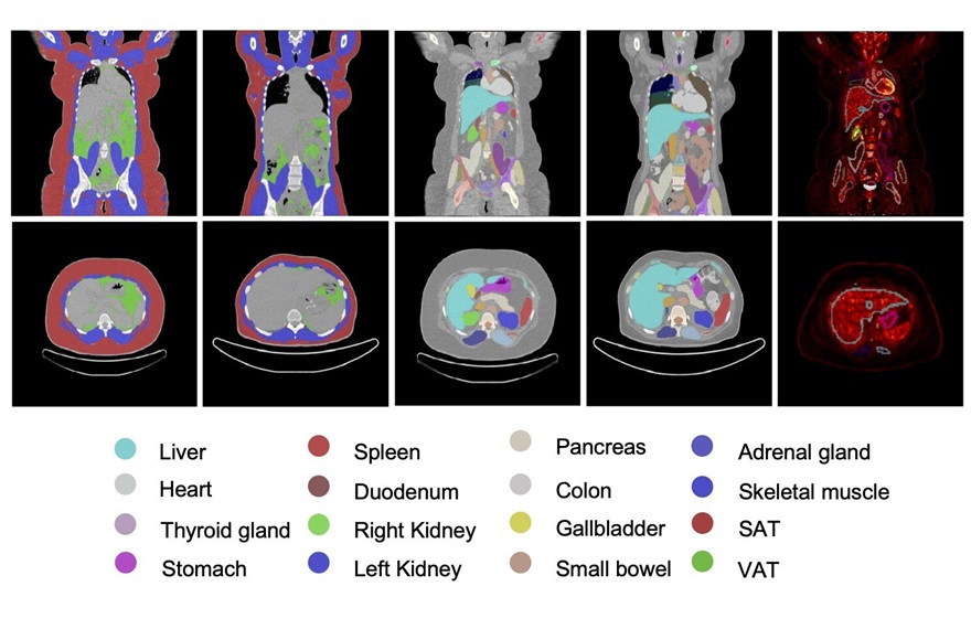 Image: Representative whole-body PET/CT based organ and tissue segmentation before and 12 months after bariatric surgery in a 20-year-old woman. Coronal PET/CT images and automated segmentation maps show multi-organ structural remodeling, including reductions in subcutaneous adipose tissue, visceral adipose tissue, liver, pancreas, spleen, and skeletal muscle, with apparent enlargement of the colon at 12-month follow-up (Photo courtesy of SNMMI)