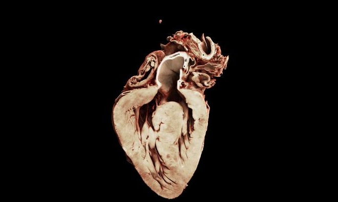 Image: Rendering of a heart with Tetralogy of Fallot showing the septal defect (Image Credit: Joseph Brunet, Cinematic Anatomy/Siemens Healthineers)