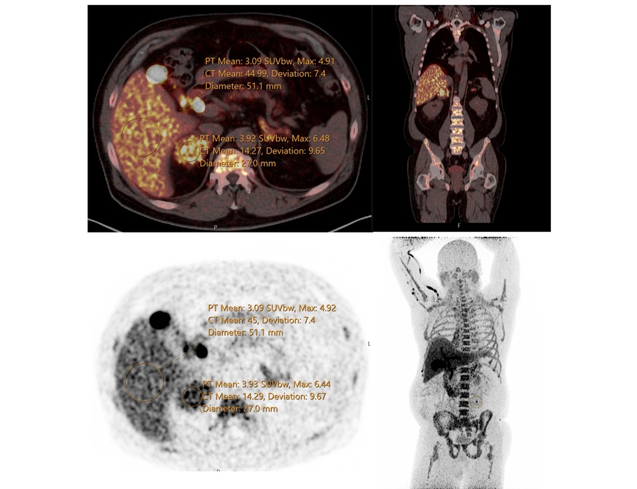 Image: Static PET-CT image of patient with hypercortisolism taken at 60 minutes post-injection (Image Credit: SNMMI)
