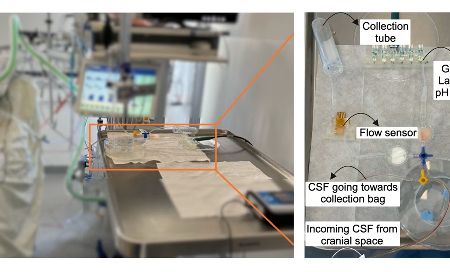 Image: The monitoring system connects to drainage lines to detect infection biomarkers, including changes in glucose, lactate, pH, and flow rate, as brain fluid moves through them (Photo courtesy of the University of Waterloo)
