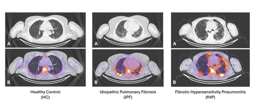 CT and fused SPECT-CT images L to R of representative healthy control, pulmonary fibrosis participant & hypersensitivity pneumonitis participant (Image courtesy of SNMMI)