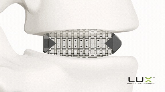 Image: The Lux Expandable Lumbar Interbody Fusion System addresses demand for an expandable construct that preserves graft capacity after expansion in lumbar interbody fusion procedures (Photo courtesy of Xenix Medical)