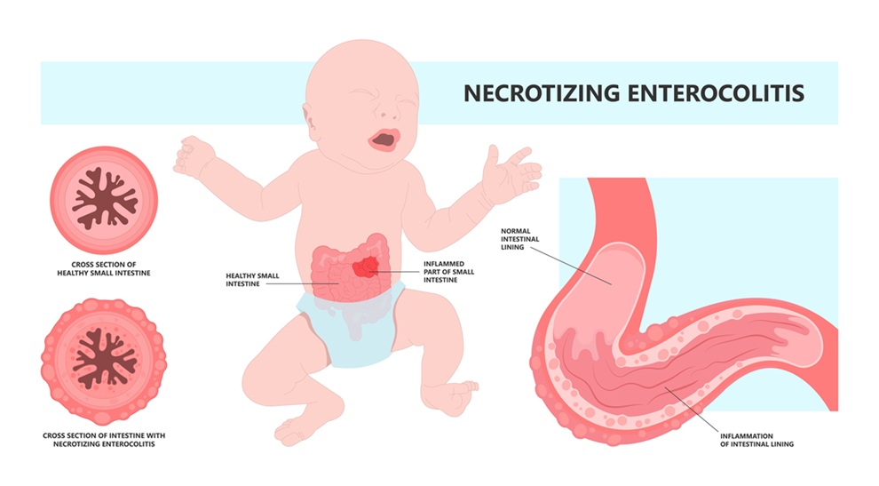 Image: Necrotizing enterocolitis is a rapidly progressive intestinal disease in premature infants that can lead to sepsis, surgery, and death, driving the need for noninvasive tools to detect early signs before damage appears on imaging (Image credit: Adobe Stock)