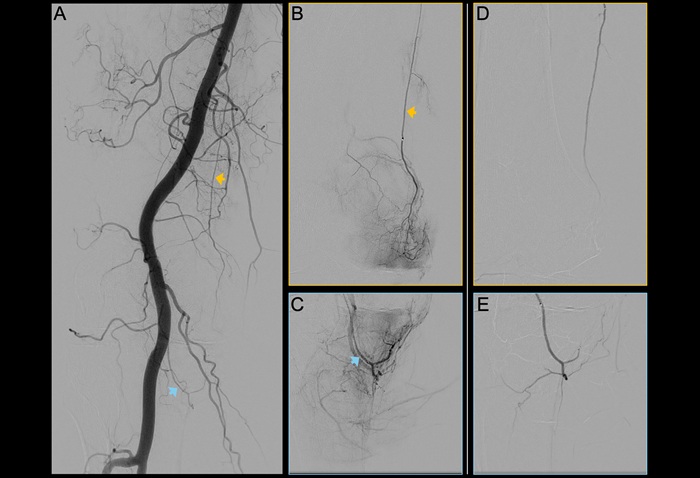 Image: Digital subtraction angiography images of the right knee joint of a 62-year-old participant with predominantly medial knee osteoarthritis (OA). (A) Periinterventional image of the popliteal artery. Yellow arrow indicates the descending genicular artery, and blue arrow indicates the medial inferior genicular artery. (B, C) Selective preinterventional images show hypervascularity of two branches of the genicular artery: the (B) descending genicular artery (arrow) and the (C) medial inferior genicular artery (arrow). (D, E) Selective postinterventional images obtained after embolization with rapidly resorbable gelatin-based microspheres (Photo courtesy of RSNA)