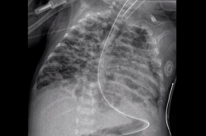 Image: Bronchopulmonary dysplasia is a chronic lung disease of prematurity that impairs lung development, prolongs oxygen dependence, and makes early risk stratification critical in neonatal intensive care (Image Credit: Pulmonological/Wikimedia Commons, CC BY-SA 3.0)