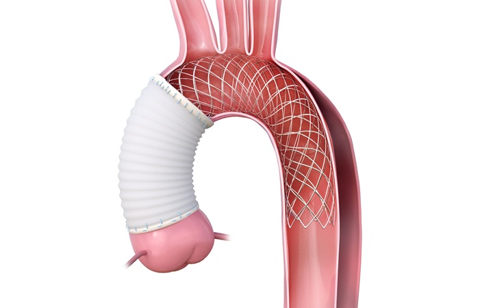 Image: AMDS is the world’s first aortic arch remodeling device for acute DeBakey Type I aortic dissections and has been shown to reduce DANE tears (Photo courtesy of Artivion
