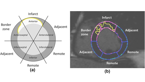 Image: (a) Classification of myocardial segments based on scar tissue extension. (b) LGE image analysis of a 52-year-old male patient with basal anterior and anteroseptal infarction. Scar tissue (yellow regions) was quantified as areas of high signal-intensity (intensity>5SDs from the remote non-infarcted segments). According to infarct extent, 6 basal segments were divided into 1 infarct, 1 border zone, 2 adjacent and 2 remote areas. (I. del Canto et al., Clinical Radiology (2026). DOI: 10.1016/j.crad.2025.1072050)