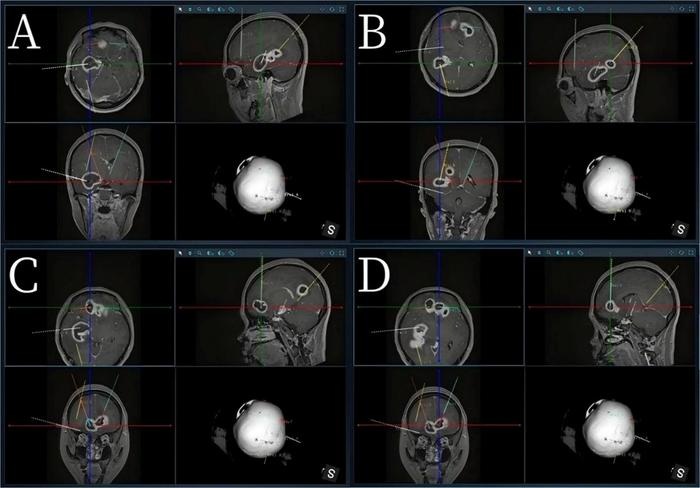 Image: Preoperative magnetic resonance imaging and intraoperative computed tomography images were fused to create a three-dimensional model of the brain, enabling surgeons to plan four precise trajectories to safely access and drain six deep brain abscesses during a single robot-assisted stereotactic procedure while avoiding critical brain structures. (Image Credit: Professor Jun Wang from Department of Neurosurgery at the First Hospital of China Medical University, China. Image source link: link.springer.com/article/10.1186/s41016-026-00436-8)