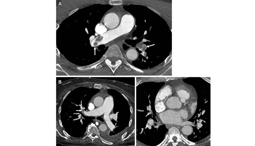 Image: Stages of thromboembolism. (A) Pulmonary embolism (PE) chest axial CT angiography image demonstrating acute pulmonary embolus (arrows). (B) PE chest axial CT angiography image demonstrating subacute pulmonary embolus (arrow). (C) PE chest axial CT angiography image demonstrating webs/scarring from prior pulmonary embolus (arrows) (Image Credit: Radiological Society of North America) Image: Stages of thromboembolism. (A) Pulmonary embolism (PE) chest axial CT angiography image demonstrating acute pulmonary embolus (arrows). (B) PE chest axial CT angiography image demonstrating subacute pulmonary embolus (arrow). (C) PE chest axial CT angiography image demonstrating webs/scarring from prior pulmonary embolus (arrows) (Image Credit: Radiological Society of North America)