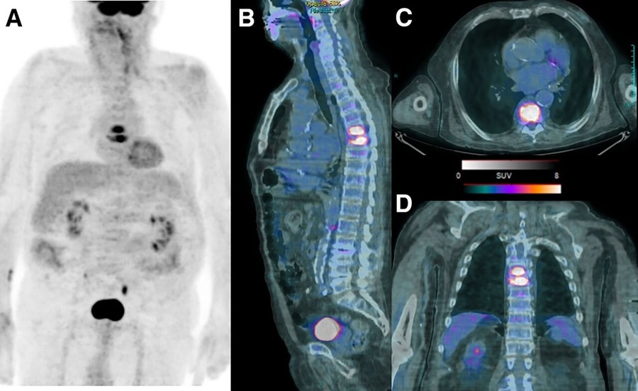 Images from a 59-year-old man admitted to intensive care unit with fever and back pain after prior intestinal surgical procedure. Despite intravenous meropenem, fever persisted. White blood cell and CRP levels were high. (A) Maximum-intensity-projection PET images showed increased uptake in column corresponding to the sixth and seventh thoracic vertebrae. Subsequent sagittal (B), axial (C), and coronal (D) PET/CT images confirmed increased 18F-FDG uptake in intervertebral disk and adjacent vertebrae in which spondylodiskitis was suspected. (Domenico Albano et al., Journal of Nuclear Medicine June 2026, 67 (6) 988-994; DOI: https://doi.org/10.2967/jnumed.125.271525)