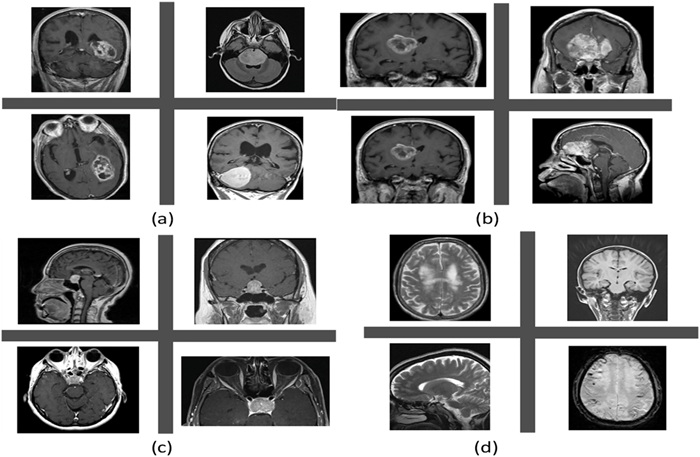 MRI scans of (a) Meningioma; (b) Glioma; (c) Pituitary brain tumor; and (d) non tumor samples (Ismail Shahin et al., Healthcare Analytics (2026). DOI: 10.1016/j.health.2026.100456)