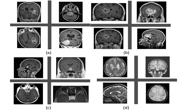 Image: MRI scans of (a) Meningioma; (b) Glioma; (c) Pituitary brain tumor; and (d) non tumor samples (Ismail Shahin et al., Healthcare Analytics (2026). DOI: 10.1016/j.health.2026.100456)