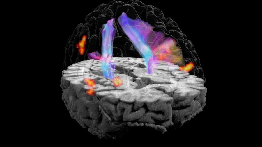 Image: A 3D view of the brain shows white matter pathways (multicolored fibers) connecting regions involved in bladder control, identified through urodynamic functional MRI (red and yellow). Researchers will examine how stroke damages this communication network and whether the resulting patterns can help predict response to treatment. (Photo courtesy of Stevens INI)