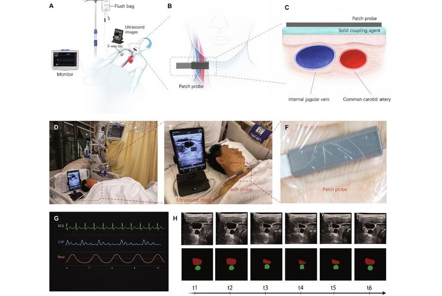 Image: (A to C) Schematic diagrams of the wearable ultrasound monitoring system for simultaneous assessment of the right internal jugular vein (IJV), common carotid artery (CCA), and central venous pressure (CVP).(D to F) Photographs of the wearable ultrasound monitoring process in a patient. (G) Bedside monitor displaying the CVP waveform, respiratory waveform, and electrocardiogram/HR signal. (H) Time-varying ultrasound images of the right IJV and CCA and their corresponding segmentation maps from t1 to t6. (Photo courtesy of Liping Zhang, Department of Emergency Medicine, Shanghai Sixth People’s Hospital, Shanghai Jiao Tong University School of Medicine)