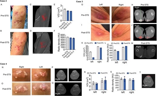 Image: Cases demonstrating scleroderma calcinosis cutis score (SC2S) reduction: intradermal sodium thiosulphate (STS) treatment of upper arm (case 2) and buttocks (case 3) calcinosis cutis (CC), topical STS treatment of patellae CC (case 4). (Ian D Odell et al. Rheumatology (2026). DOI: 10.1093/rheumatology/keag302)