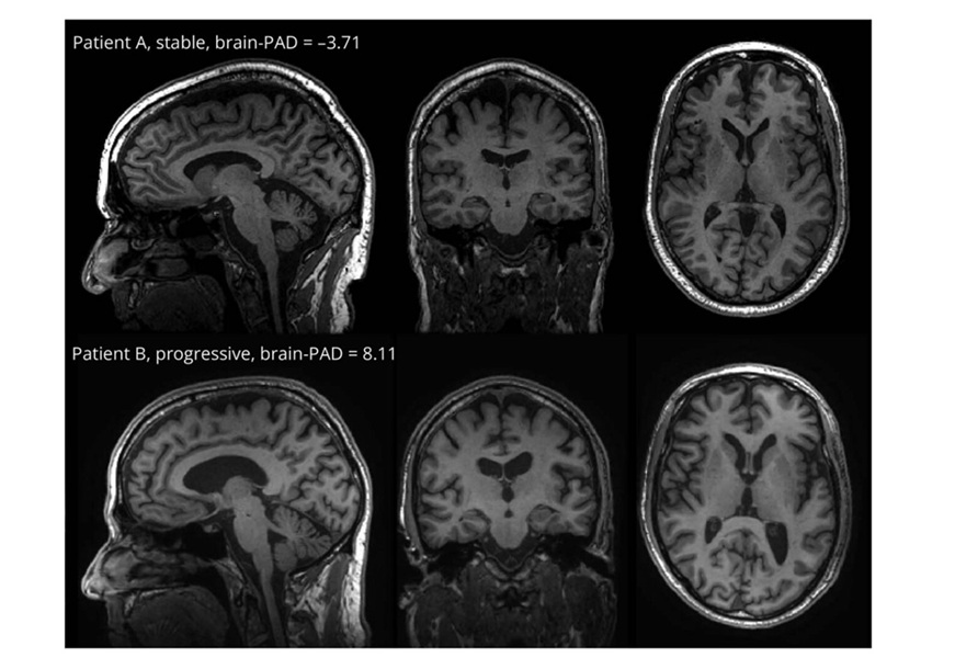 Image: The MRI-derived “brain age” metric offers a sensitive, automated measure that could complement existing visual scales for earlier risk stratification (Stefan De Vries et al., Neurology (2026). DOI: 10.1212/wnl.0000000000218418)