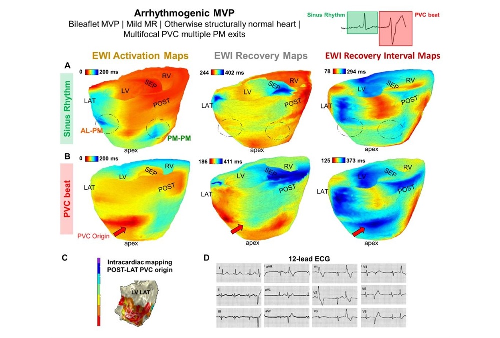 Image: EWI imaging of a 22-year-old female patient with mitral valve prolapse and an abnormal heart rhythm ((Melina Tourni et al., Proceedings of the National Academy of Sciences, 2026. DOI: 10.1073/pnas.2503559123)