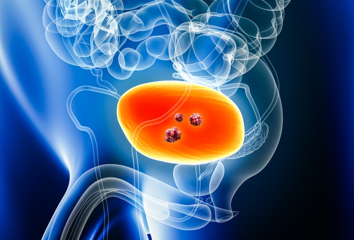 Image: New research shows incorporating AI-based risk assessment into routine clinical data could help identify bladder cancer at its earliest, most treatable stages (Image Credit: iStock)