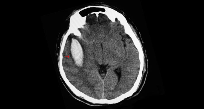 Image: The software analyzes early brain imaging changes together with clinical variables to generate a patient-level risk estimate for malignant cerebral edema after acute ischemic stroke.(Photo courtesy of Sopone Nawoot/Dreamstime.com)